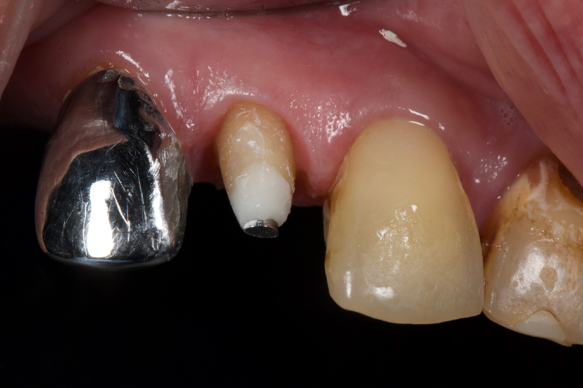 Подготовленный зуб под коронку.