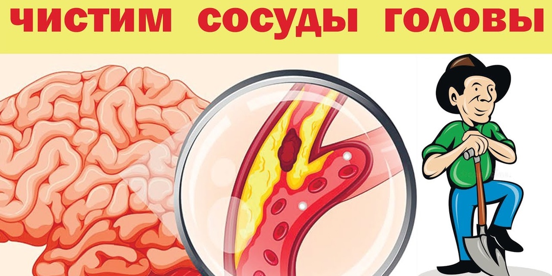 Почему шум в голове может быть первым признаком атеросклероза