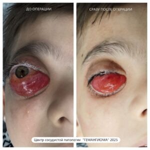 Фото пациента "до" и сразу после операции.