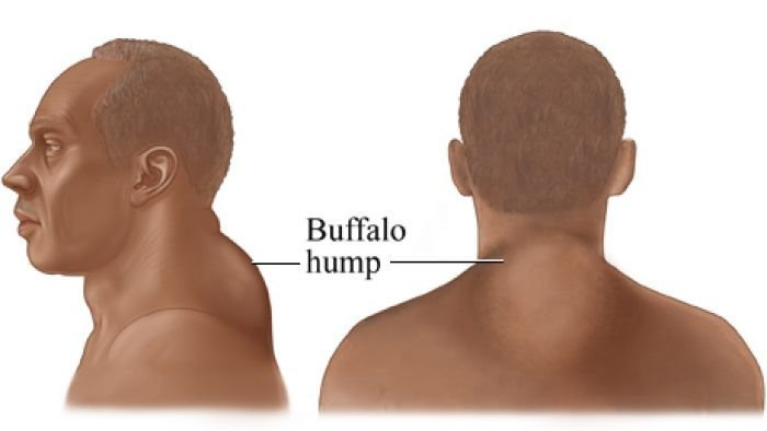 Горб буйвола
