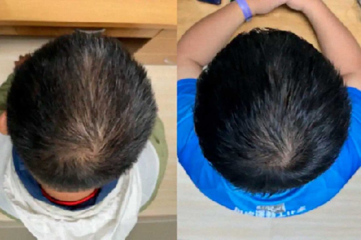    Участники эксперимента наносили по одному миллилитру средства на всю поверхность головы каждый вечер в течение 56 дней / © Tsong-Min Chang et al. 2025