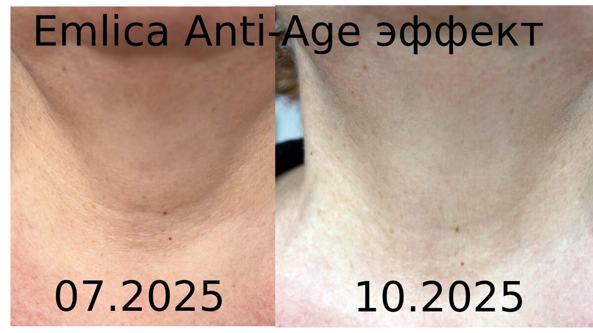 Женщина 60 лет. Достаточно сложно передать разницу за 3 месяца, но сразу видно, что кожа подтянулась, кольца стали намного менее выражены. 