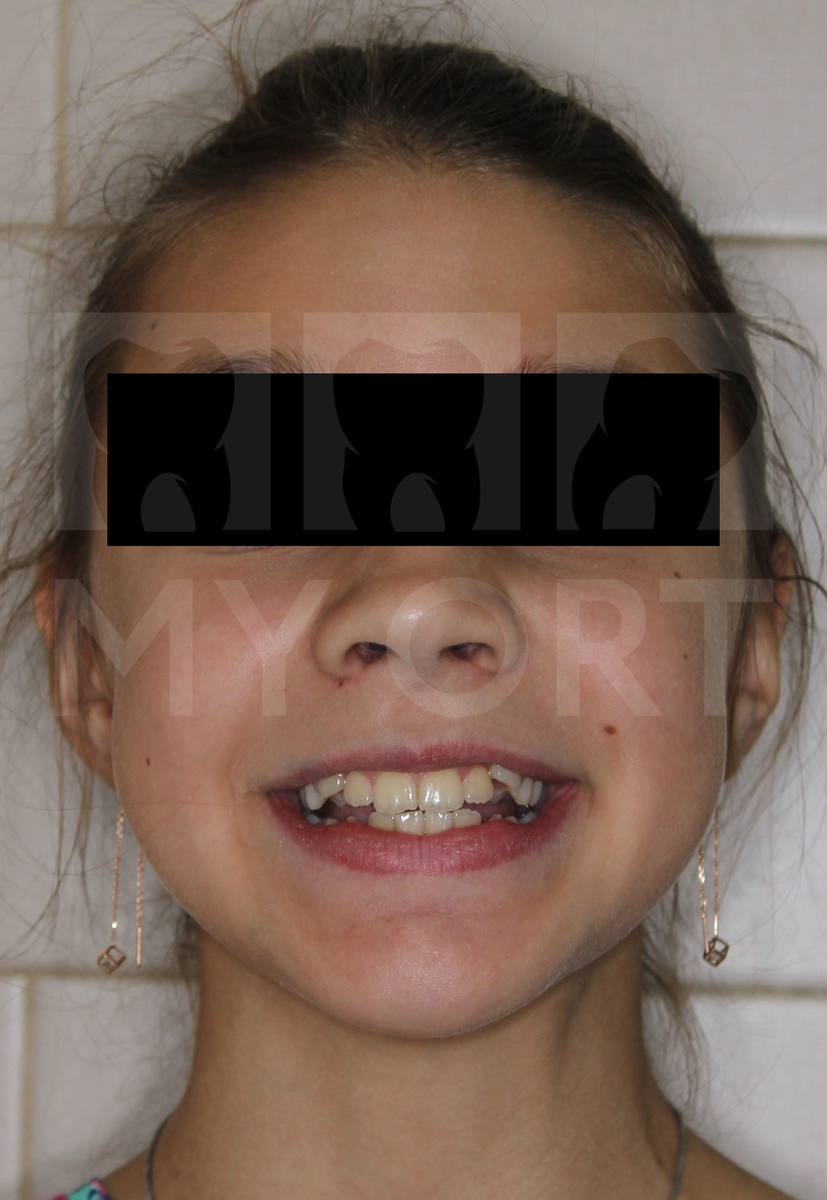 Неровные зубы и неправильное положение клыков на верхней челюсти ->