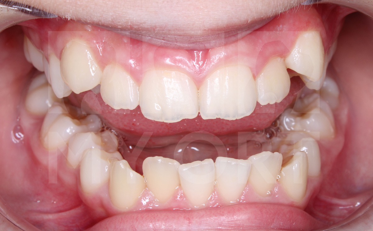 Неровные зубы и неправильное положение клыков на верхней челюсти ->