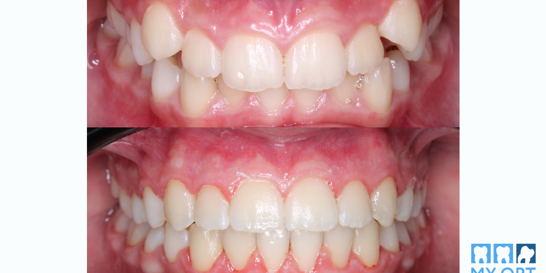 Как мотивация ребёнка 11 лет помогла исправить дистальный прикус без сложных аппаратов. Клинический случаи