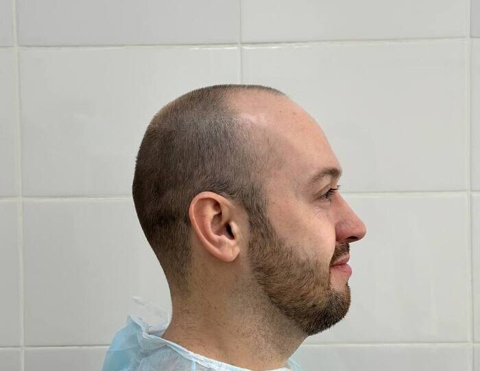 История: пересадка волос в клинике в России с турецким доктором⁠⁠