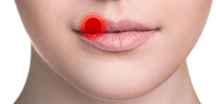 Герпес на губах: откуда он берётся, почему возвращается и как с ним жить без паники