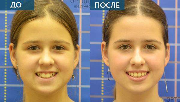 Лечение аппаратом alf и брекетами до и после