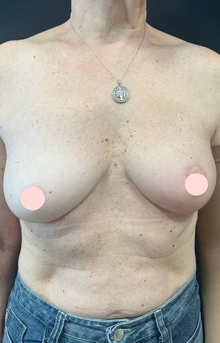 На фотографиях вы видите результат лечения спустя год после операции и пол года после лучевой терапии.