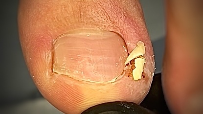 Как вросший сегмент роет подкоп вдоль боковой пазухи