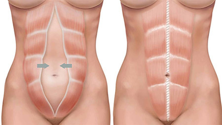 Диастаз прямых мышц живота. Источник: https://www.swiss-clinic.ru/metodiki/operatsii-pri-diastaze-pryamykh-myshts-zhivota/