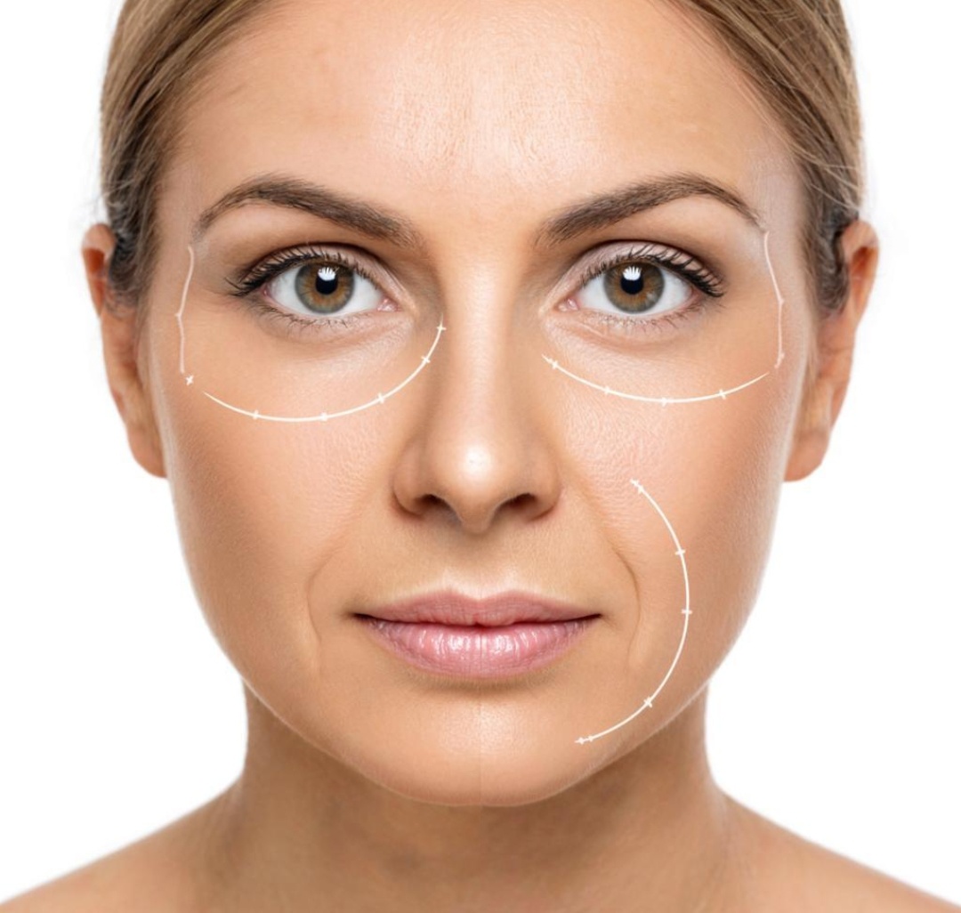 Морщины марионетки