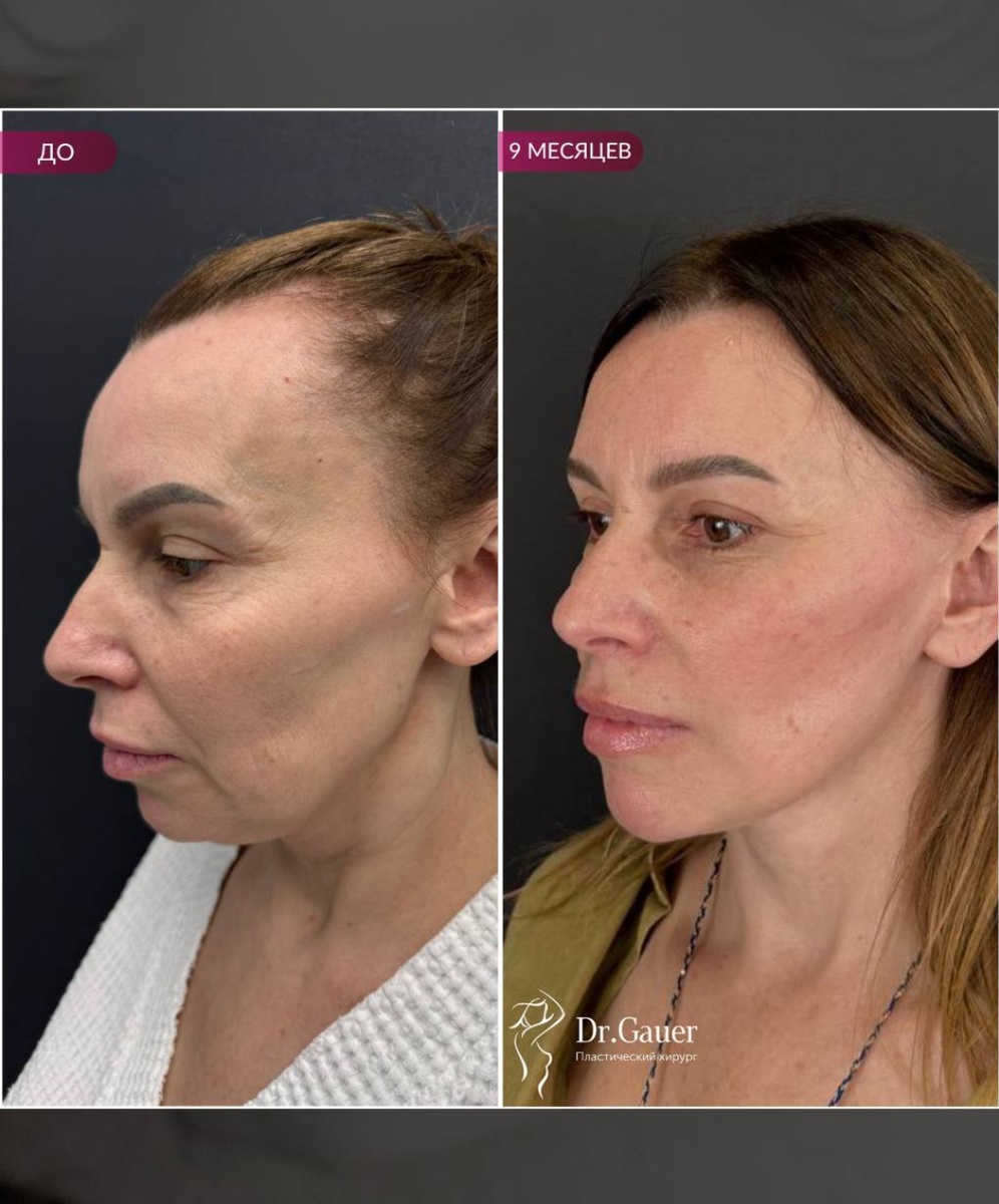 Как убрать моршины марионетки 