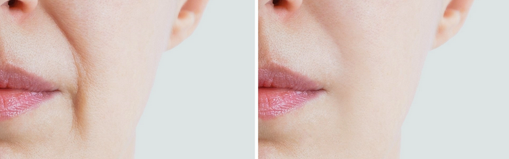 До - После - 4 месяца регулярного выполнения правил из статьи