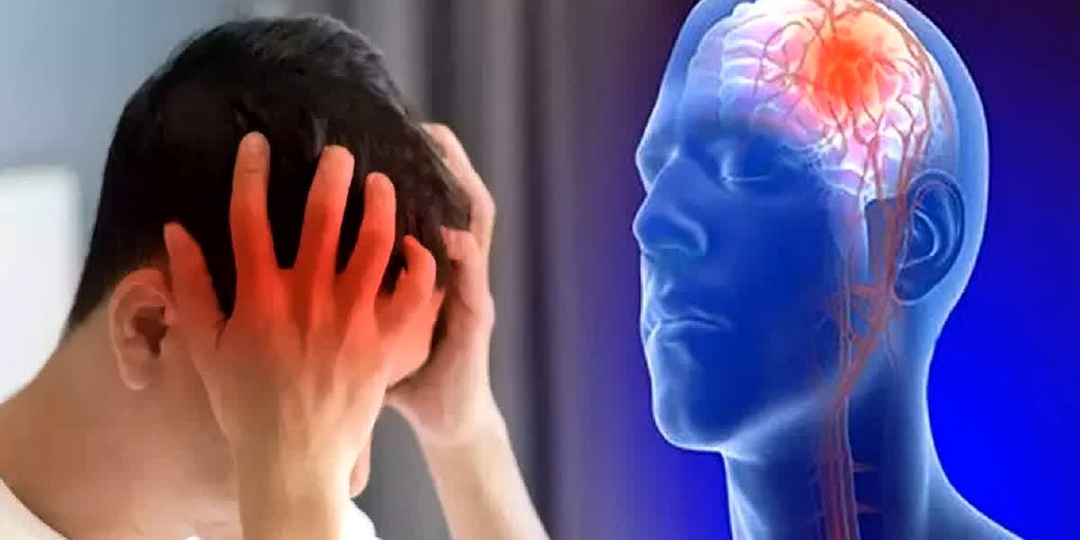 Что такое инсульт?