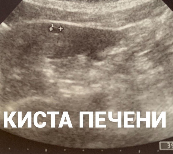 Кисты в печени и почках: не паниковать, а разобраться!