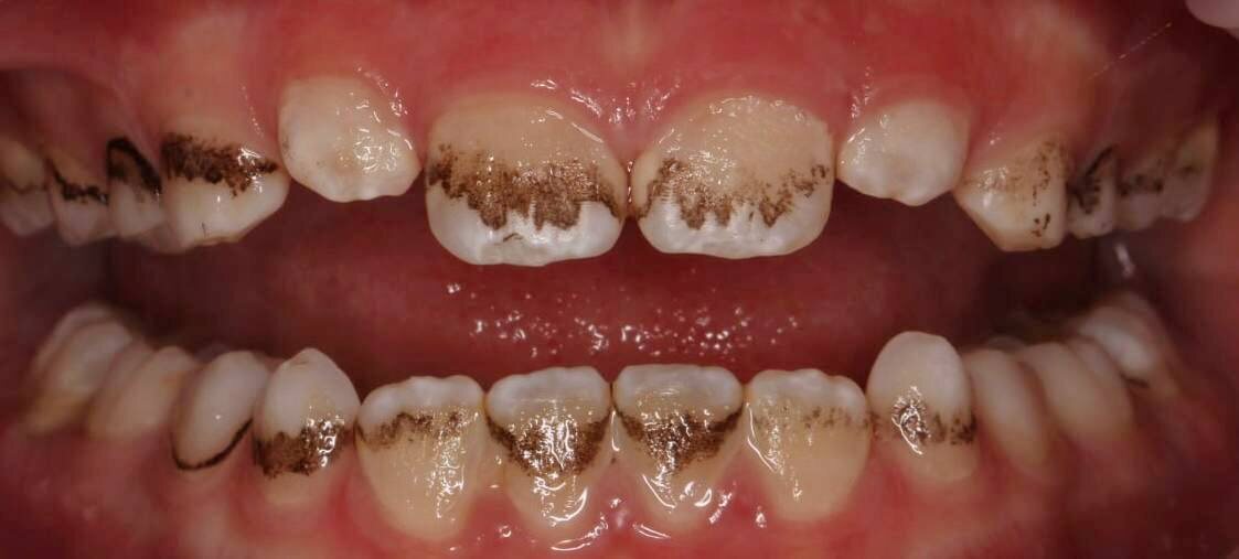 Так выглядит налёт Пристли. Кейс из практики Кристины Геннадьевны. 
