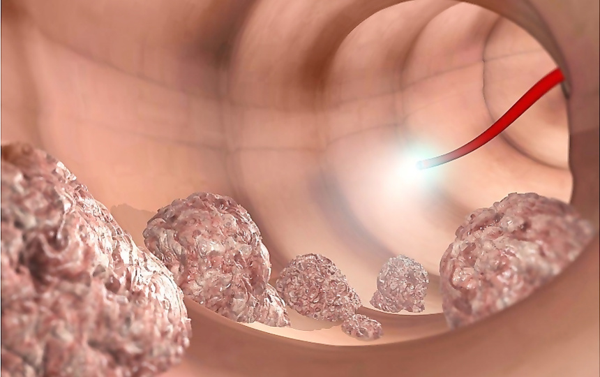 Полипы в организме: не всегда страшно, но всегда важно знать — что это такое, где появляются и когда стоит бить тревогу