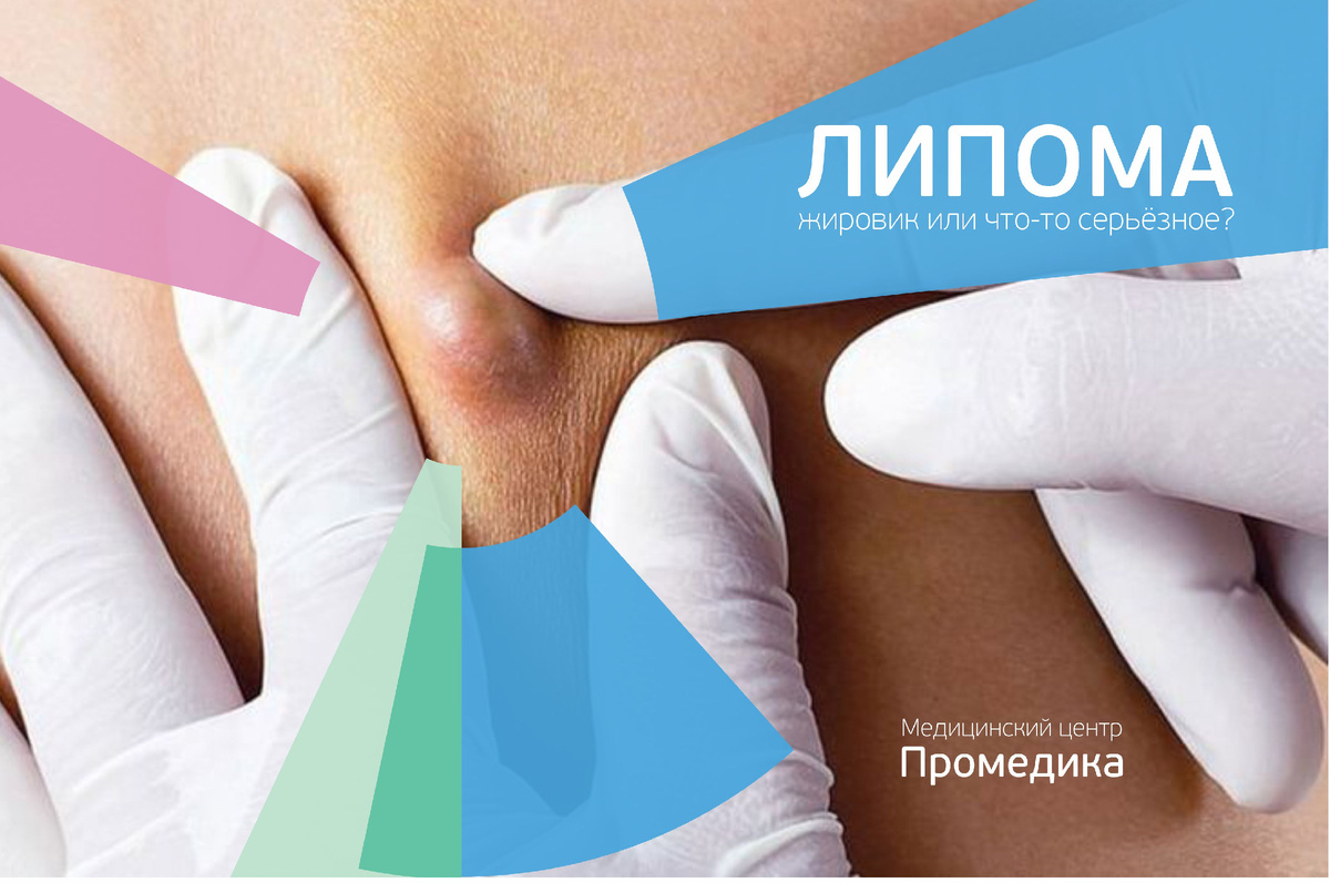 Липома. Жировик или что-то серьёзное? Как отличить липому от опасного образования 