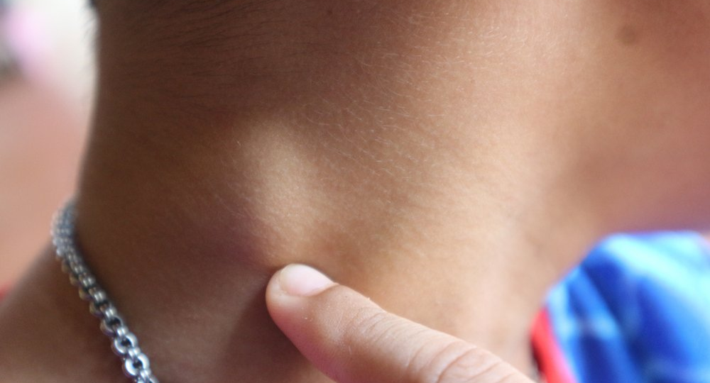 Иммунолог рассказала, какие болезни нужно исключить при увеличении лимфоузлов на шее