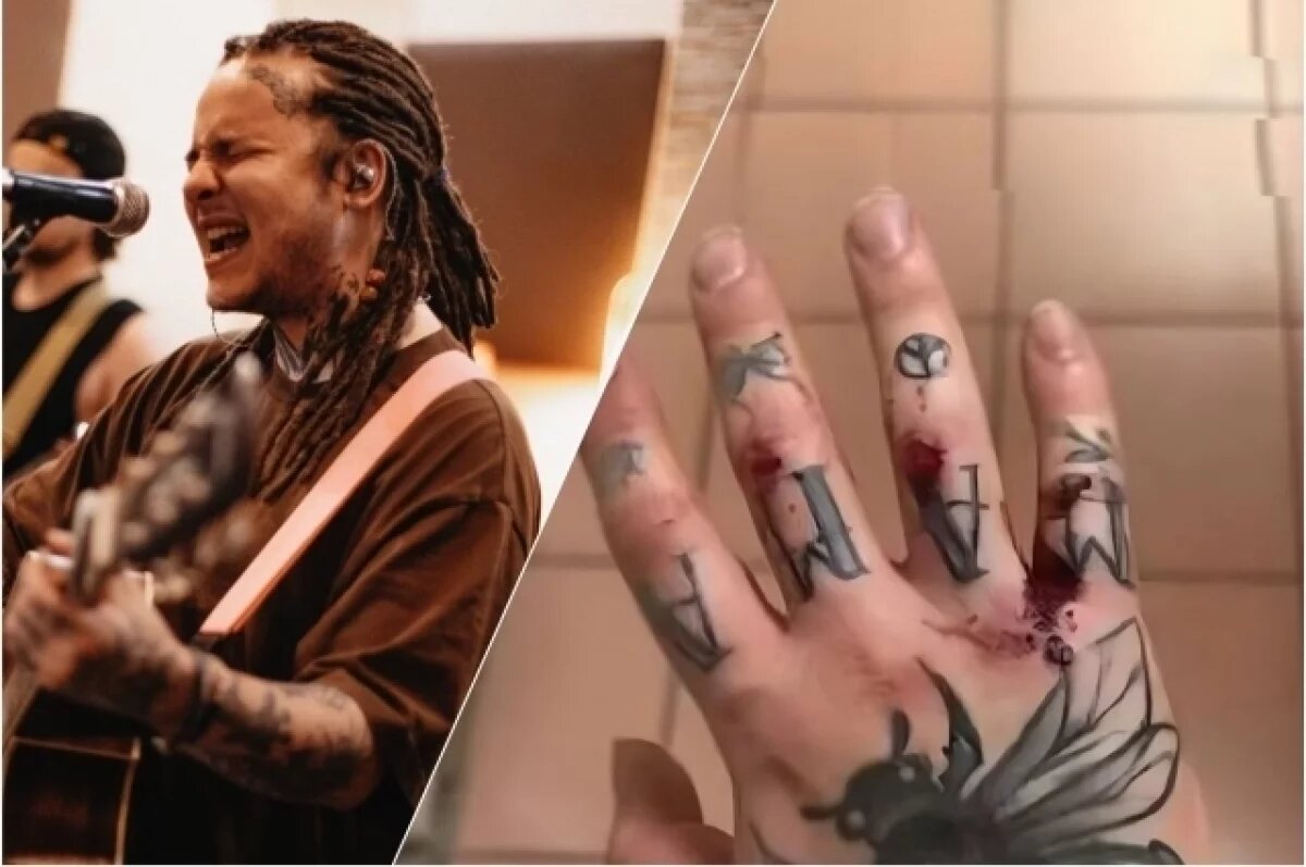    Сломали руку?