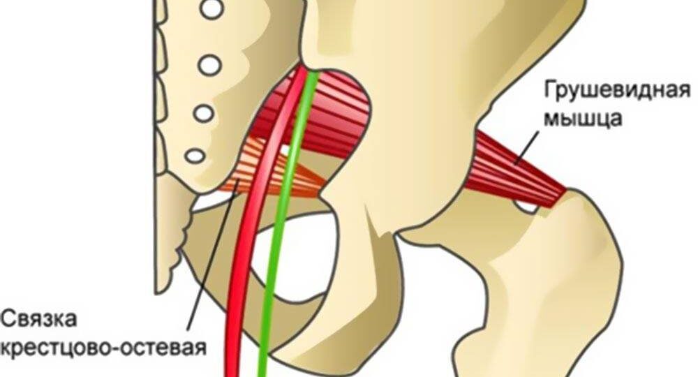 "Синдром грушевидной мышцы: когда обычная боль в ягодице превращается в ежедневное испытание"