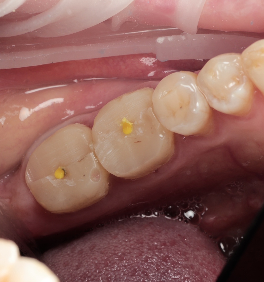 "Билдап", выполненный в другой клинике - с этим пациентка обратилась к нам