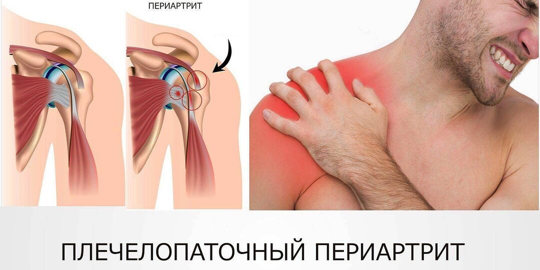 Плечелопаточный периартрит: Как не запустить болезнь до состояния «замороженного плеча»