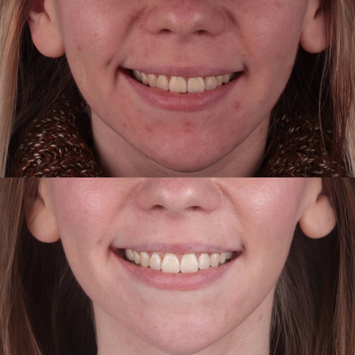 Как вылечили ВНЧС и исправили прикус за 15 месяцев без операции