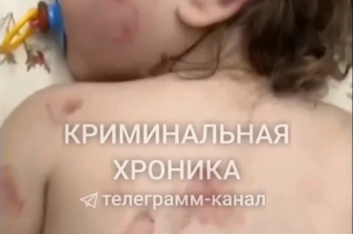    В Дагестане мама искусанной в детсаду девочки не хочет возбуждения дела
