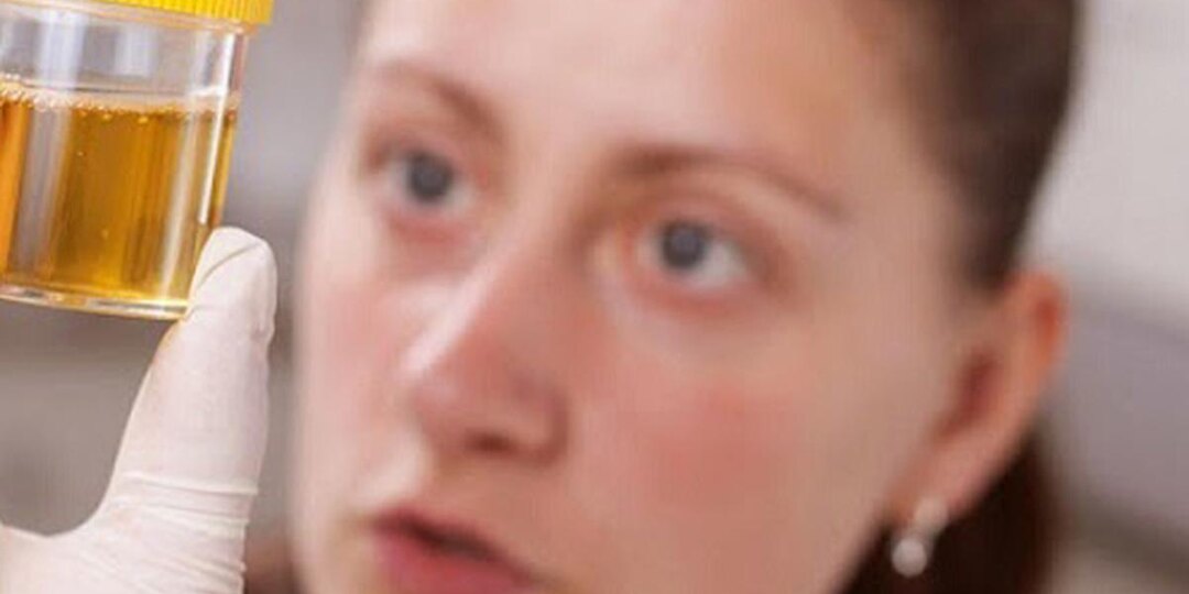 Что цвет мочи может рассказать о вашем здоровье