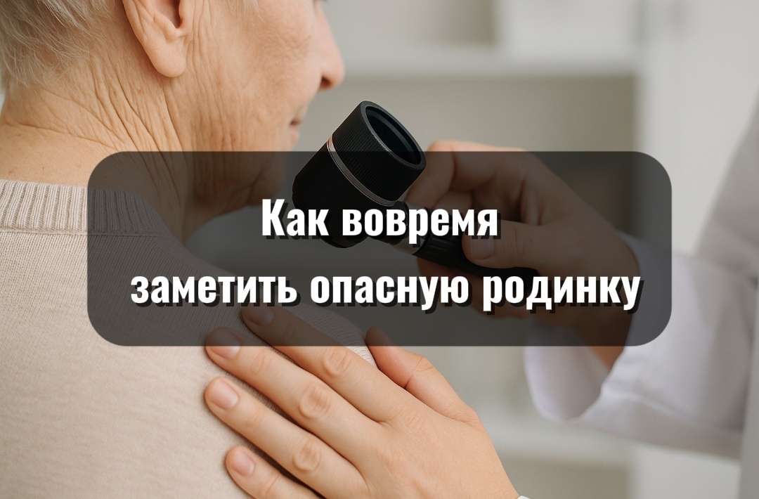 Не каждая родинка опасна. Но если вы заметили, что у близкого изменилась форма или цвет пятна на коже — не откладывайте проверку. Иногда именно такие мелочи спасают жизнь.
