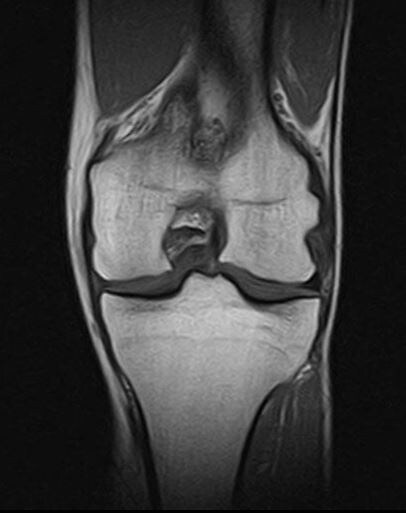 МРТ коленного сустава