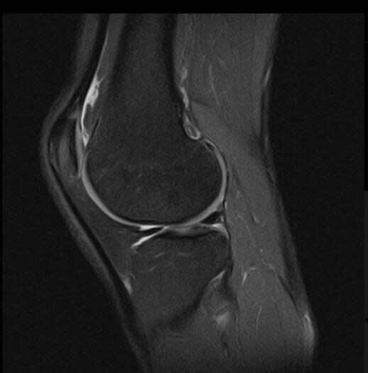 МРТ коленного сустава