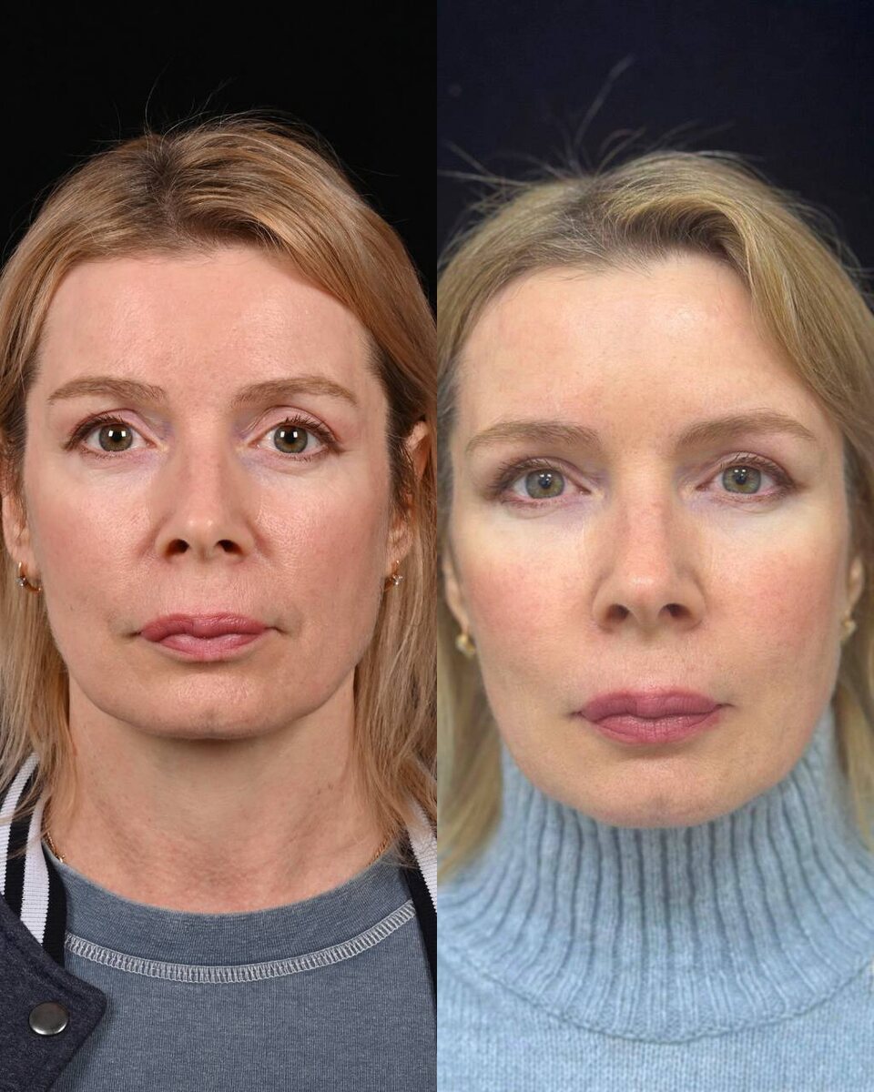 Пластика верхних век + липофилинг средней зоны лица фото до и после. Фото с сайта хирурга Д.Р. Гришкяна. Имеются противопоказания, требуется консультация специалиста