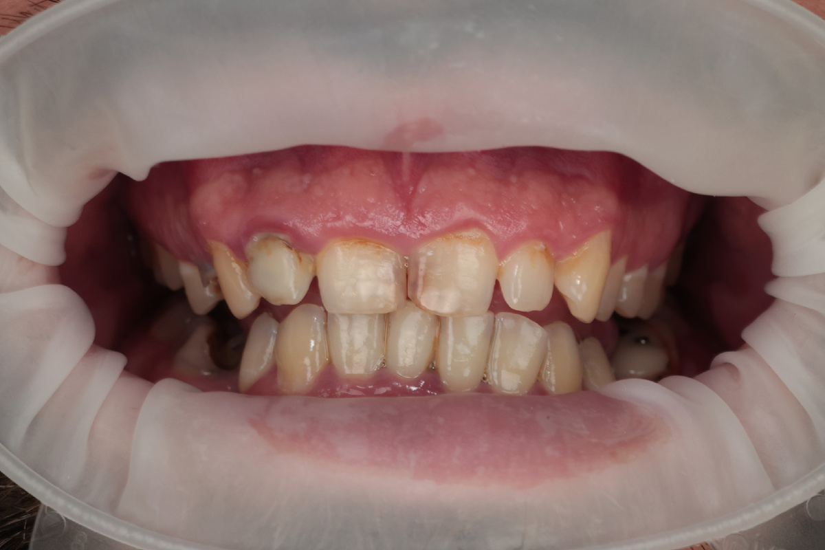 Зубы без ухода 20 лет 