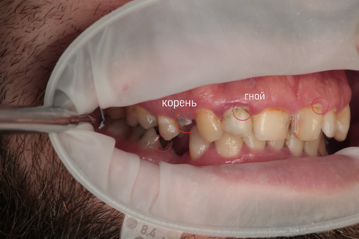 Корень, гной, отсутствующие зубы, налет 