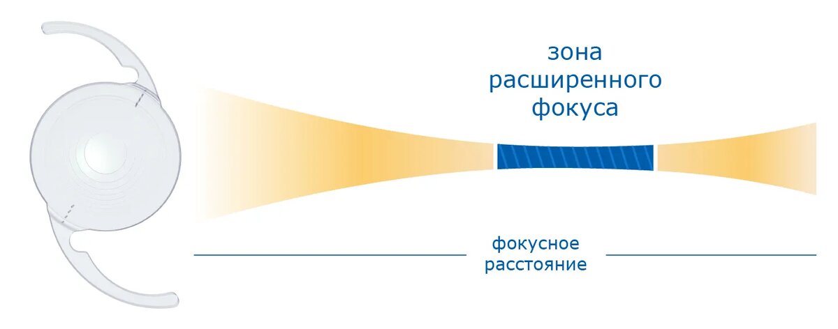 Как  работает технология EDOF. Источник: "Эксимер"