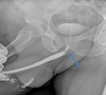 Рис. 2. Уретрография пациента до операции. Стриктура уретры показана стрелкой. 