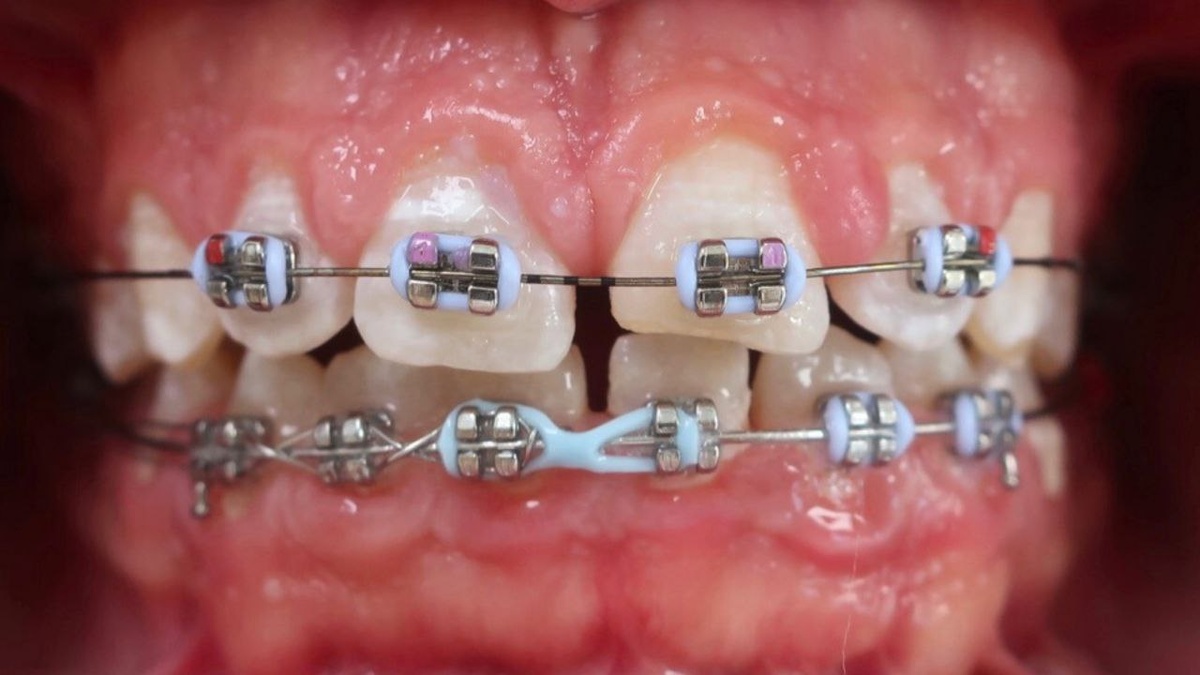 Частичная брекет-система. Кейс Владимира  Эммануиловича.
