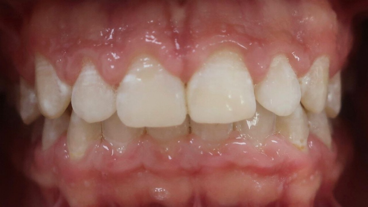 После снятия частичной брекет-системы.