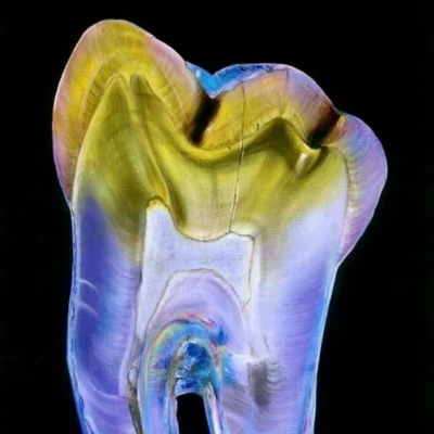 Чем тверже и насыщенней эмаль, тем устойчивее она к кариесу