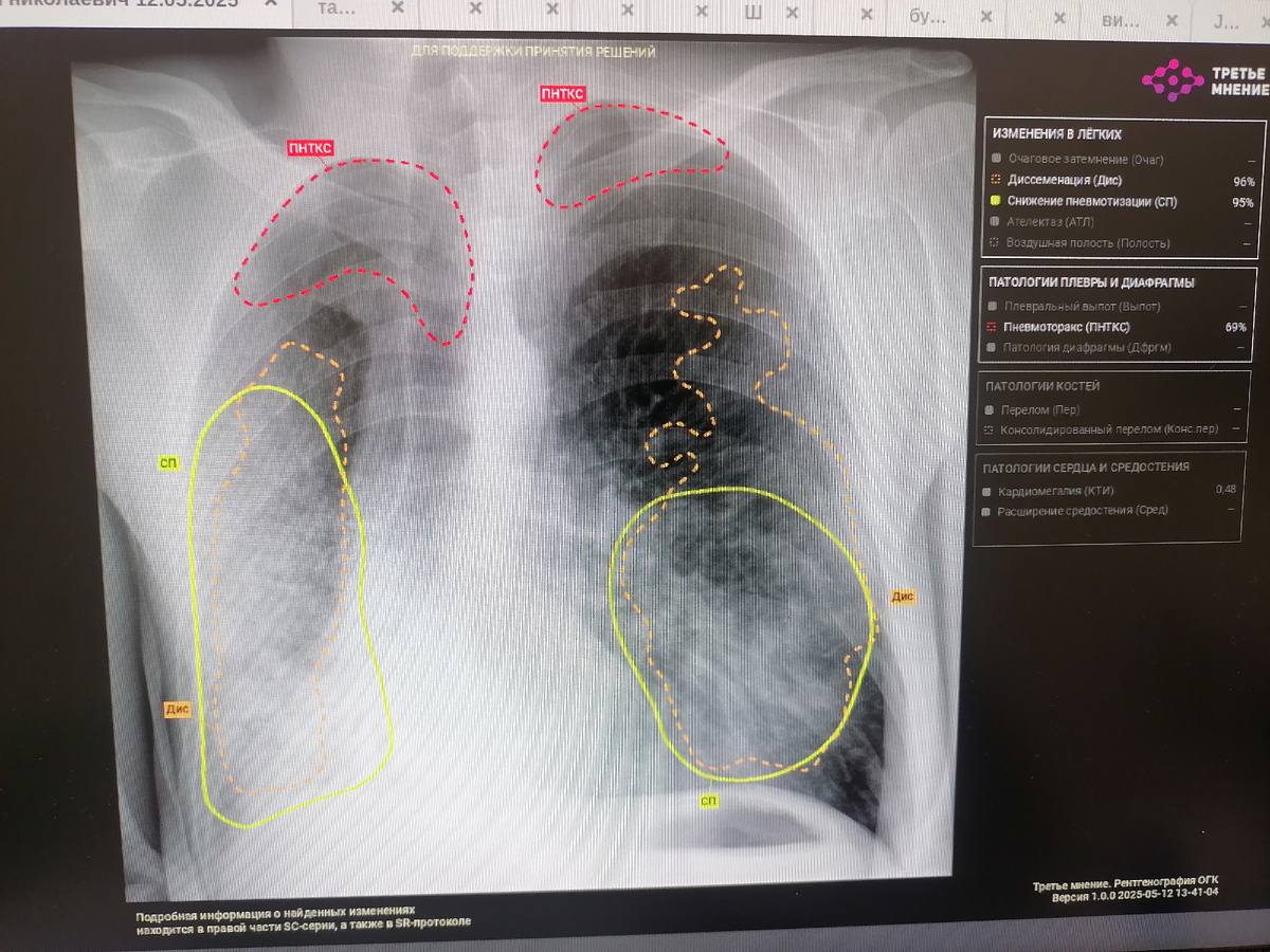 Так называемая "тепловая карта", где разными цветами подсвечены патологические участки.