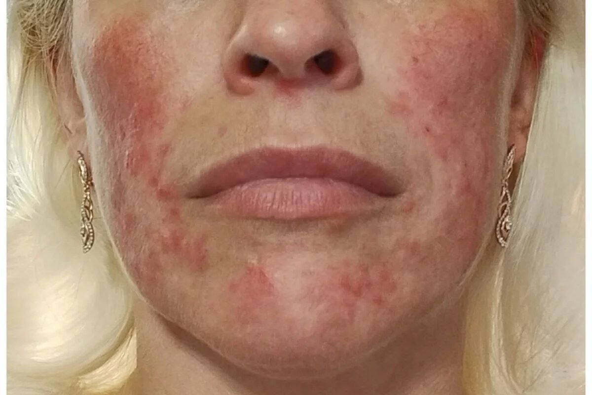   Самолечение от акне привело псковичку к стероидному дерматиту