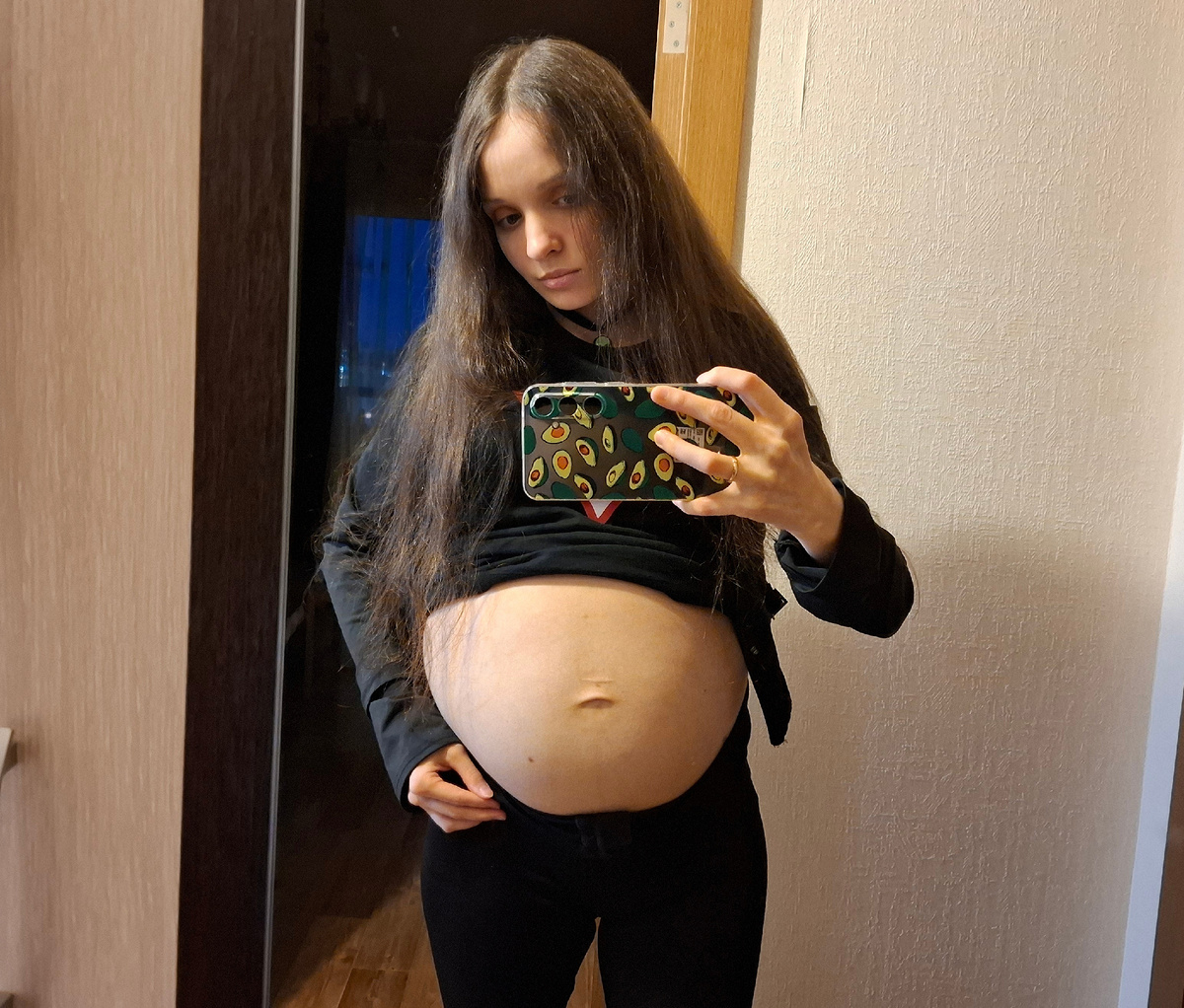 Живот через 2 месяца после лапароцентеза