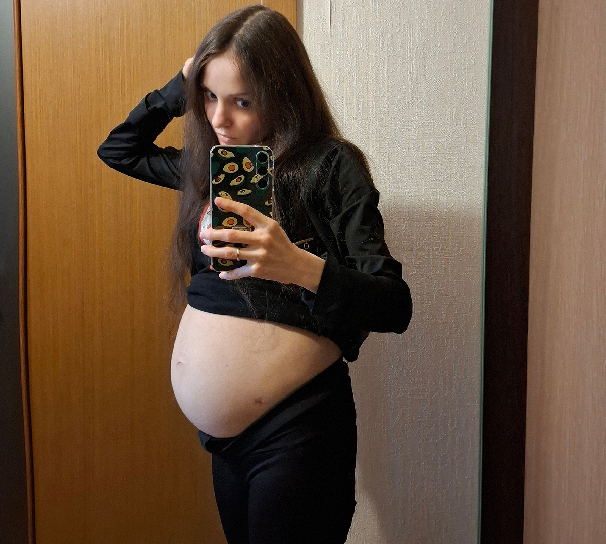 Асцит после лапароцентеза