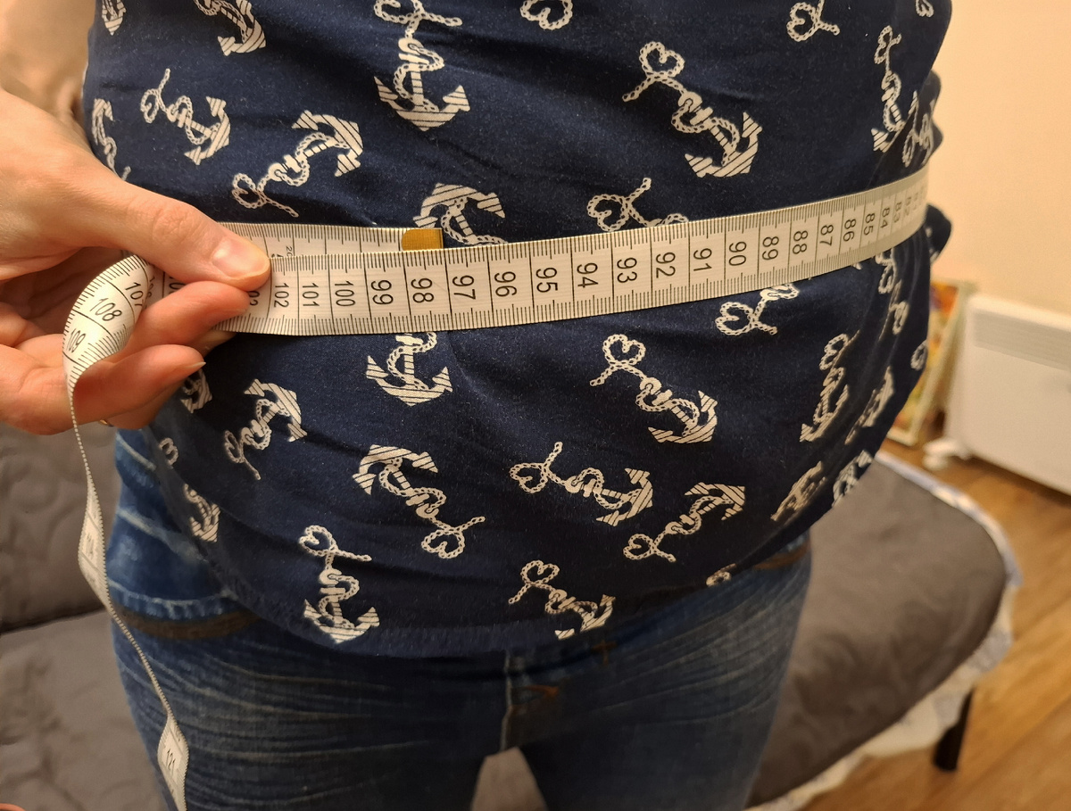 Живот через 2 месяца после лапароцентеза