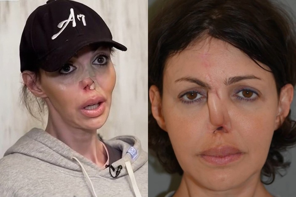    Алиса Аршавина почти лишилась носа. Фото: кадры видео.