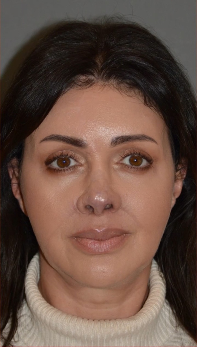    Сейчас Алиса выглядит вот так: хирург показал результат финального этапа реконструкции носа. Фото: кадр видео.