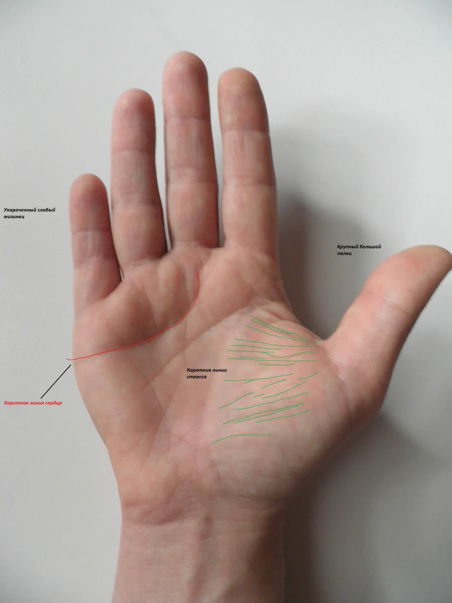 Примерная совокупность знаков при демонстративном характере : мощный большой палец(сильный, эгоистичный характер), короткая линия сердца (себя любит больше, чем других), много коротких линий стресса (беспокоится в основном только о себе - зациклена на себе, как пуп земли). Фото Яндекс картинки.